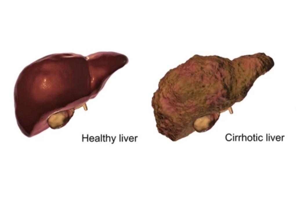 Back To My Transplant&nbsp;Story